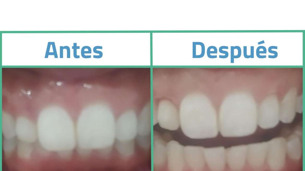 Recorte Gingival o Gingivectomía